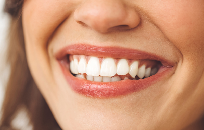 Tratamientos Incluidos en el Diseño de Sonrisa