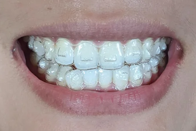 Descubriendo la transformación: Los beneficios de Invisalign