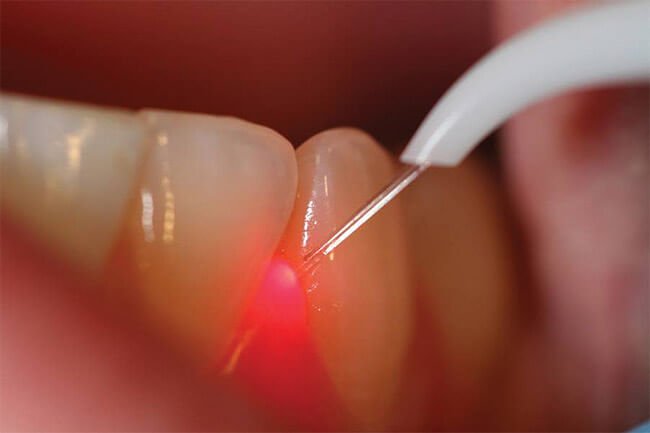 Descubra los beneficios de la odontología láser con la Dra. Mónica Morgan