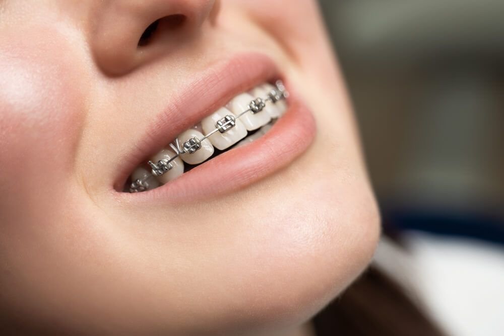 Innovaciones en ortodoncia: más allá de los brackets tradicionales